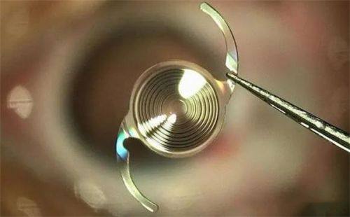 二、深圳佰视佳眼科医院技术怎么样?