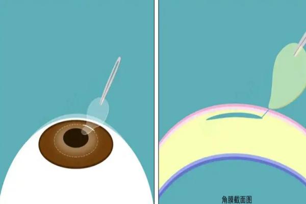 大连爱尔眼科医院治疗白内障怎么样？连锁品牌技术口碑双优！ 