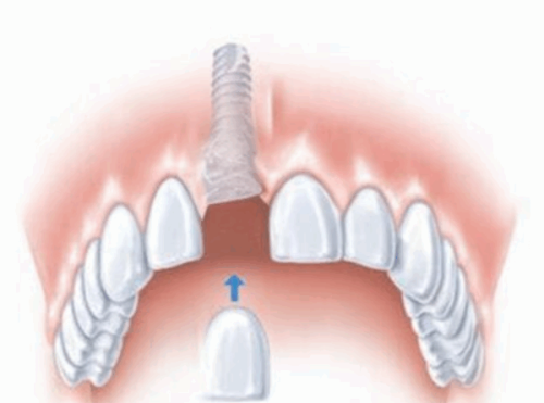 二、常州中诺口腔医院价格：集采后“性价比爆炸”，种植牙超便宜！