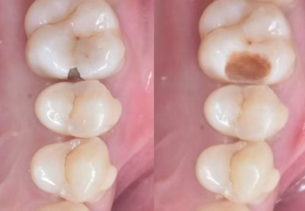 三、意大利BB和韩国种植体适合哪些人？术前要做什么检查？www.ybbee.com/