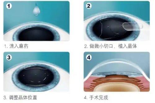 二、三亚明朗眼科医院屈光手术特色解析www.ybbee.com/