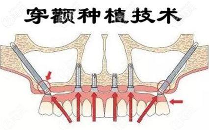 一、无锡中诺口腔医院李华磊做穿颧种植厉害吗www.ybbee.com/