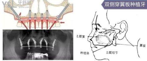 二、无锡中诺口腔医院鲁百强穿翼板种植牙技术实例多吗相关费用与预约指引www.ybbee.com/